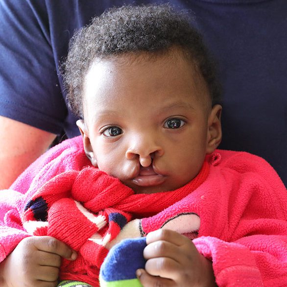 Jony-0423_FLM_1054-cropped Jony before surgery